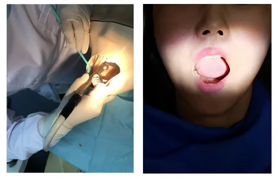 LED-vs-halogen-dental-light-comparison
